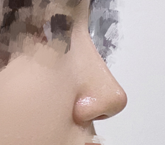 I Think Getting Nose Surgery Was the Right Choice haha