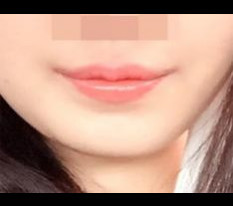 Lip corner surgery is amazing
