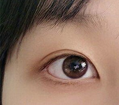 Came to leave another review at 3 months after double eyelid surgery