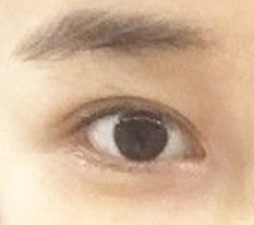 After revision double-eyelid surgery, my line came back.. sob