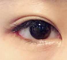 How is the lateral canthoplasty revision and lower canthoplasty?!