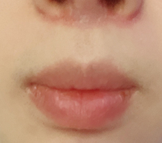 It's been 2 weeks since my philtrum reduction surgery — I'm satisfied