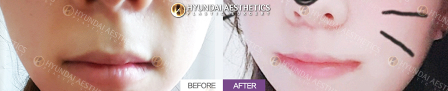 Philtrum Reduction + Mouth Corner Lift