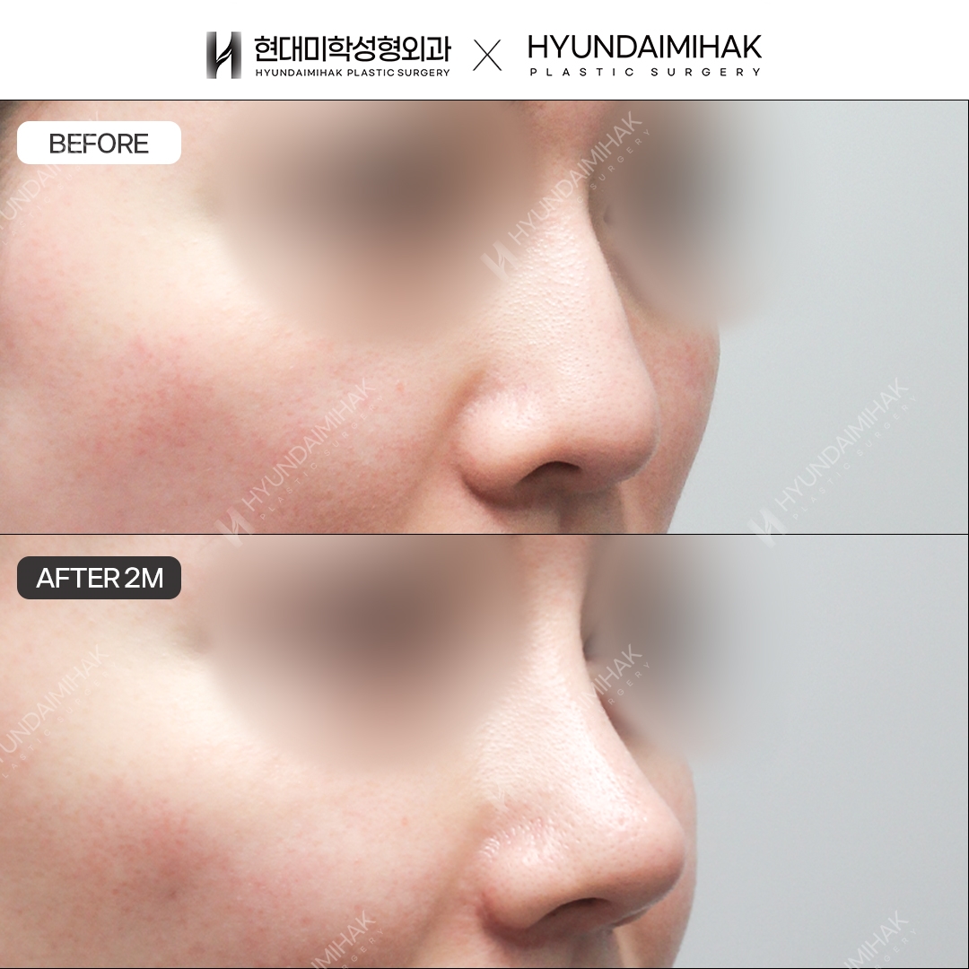 [Hump nose rhinoplasty] Nasal bridge + nasal tip, 2 months post-op