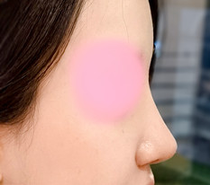My nose became slim