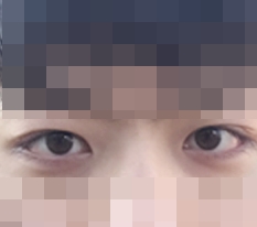The double eyelids I wanted to have