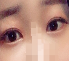 Dual Canthoplasty and Epicanthoplasty