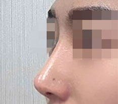 After my nose job I keep getting told I've become handsome