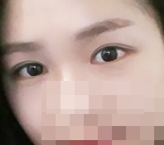 Eye Incision, Eye-Shape Correction, Front and Back Canthoplasty