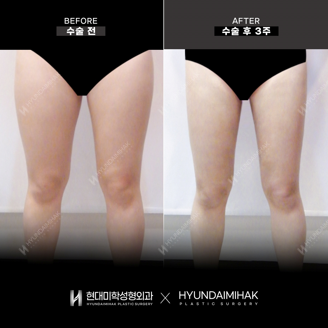 3 weeks after thigh liposuction