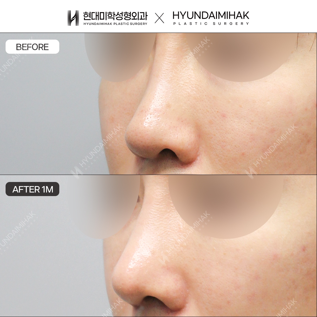 [Male Rhinoplasty] Bridge + Tip, 1 Month