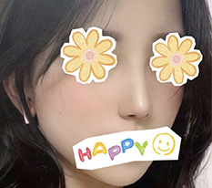 It's been 7 months since my rhinoplasty at Hyundai Aesthetic Surgery ㅎㅎㅎ