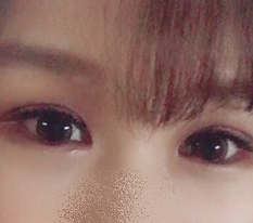 My eyes changed completely with double eyelid surgery ♥