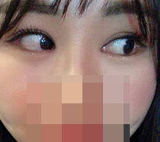 Dual canthoplasty really seems to change the impression a lot ^^