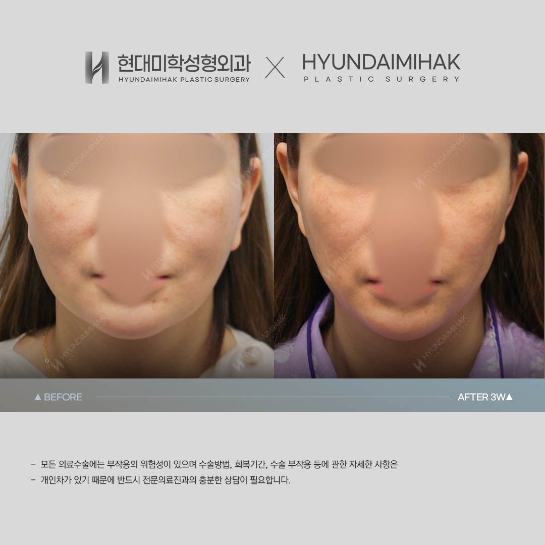 [Anti-aging Surgery] Thread lift, 3 weeks