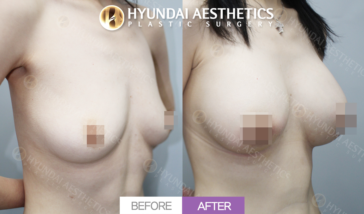 Sagging Breast Correction + Breast Volume Correction