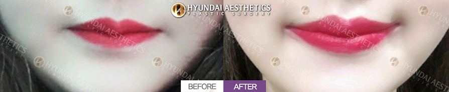 Mouth Corner Lift
