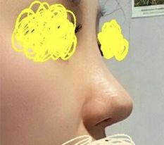 Back with my week-3 nose surgery review
