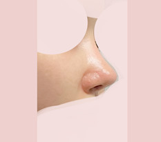 My bulbous nose problem solved