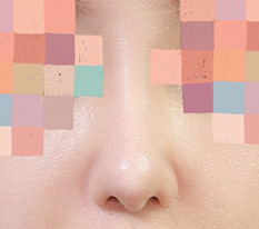Nose revision with autologous rib cartilage