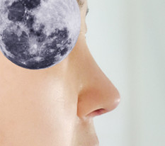 My first nose surgery