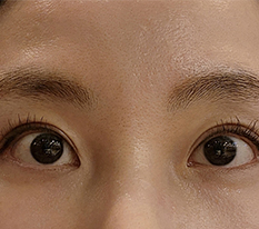 Revision eye surgery with no swelling!