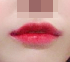 All thanks to lip corner surgery!