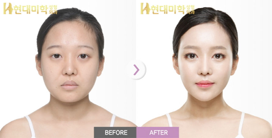 Eyes (Incision), Epicanthoplasty, Lateral Canthoplasty, Lower Canthoplasty, Fat Grafting