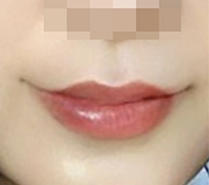 Wow, improving my drooping mouth corners was a success!!!!!!!!