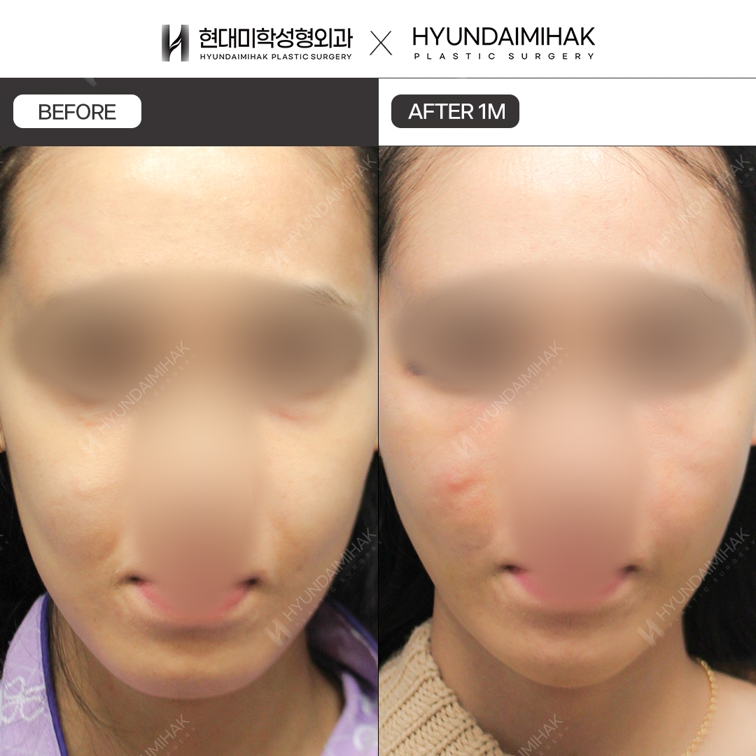 [Facial Rejuvenation] Thread Lift, 1 Month Later