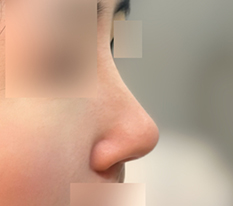 I corrected my long nose
