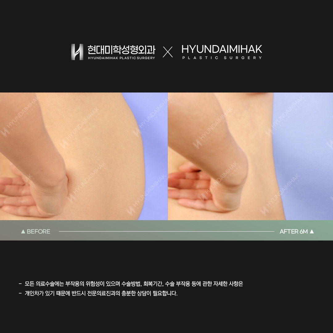 Abdominal Liposuction, 6 Months Later