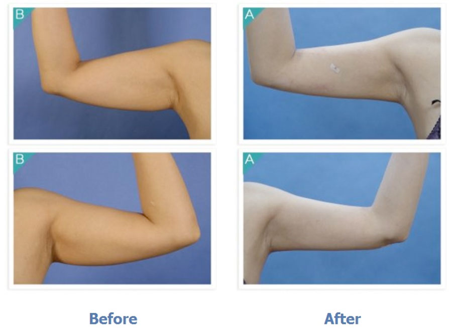 Body Contouring / Arm Liposuction