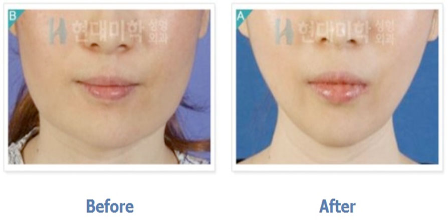 Square Jaw Surgery