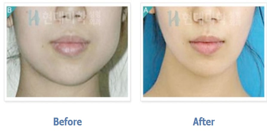 Square Jaw Surgery