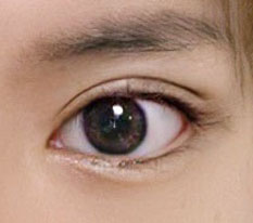 One month after eye revision + canthoplasty and the doctor's skill is truly amazing