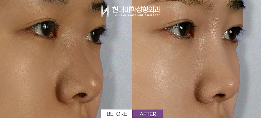 Rhinoplasty