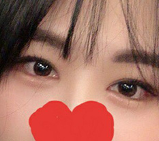 Completely satisfied review of dual canthoplasty^^