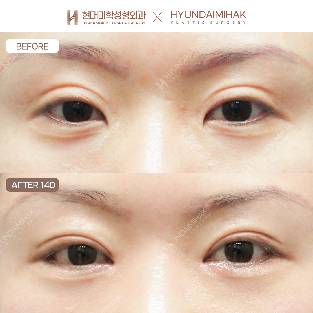 [Eye revision surgery] Incisional crease-line lowering + eye shape correction + medial epicanthoplasty