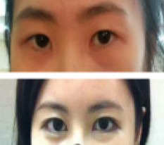 Found my confidence with just eye surgery♥
