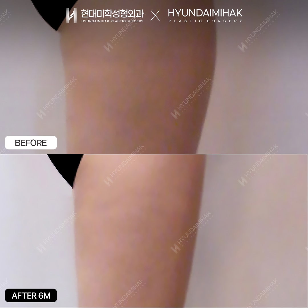 Thigh Liposuction, 6 Months Later