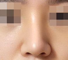 My very first rhinoplasty and I love it haha