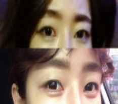 After Filler, I Became a Cutie >3<
