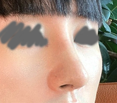 Fixed my hooked nose and people say I look more masculine now