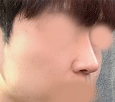 Male Nose Surgery Review