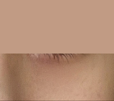 My impression changed with under-eye fat repositioning!