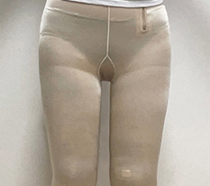 From Severe Lower-Body Obesity