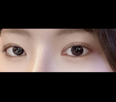 My Eye Surgery Came Out Really Well!