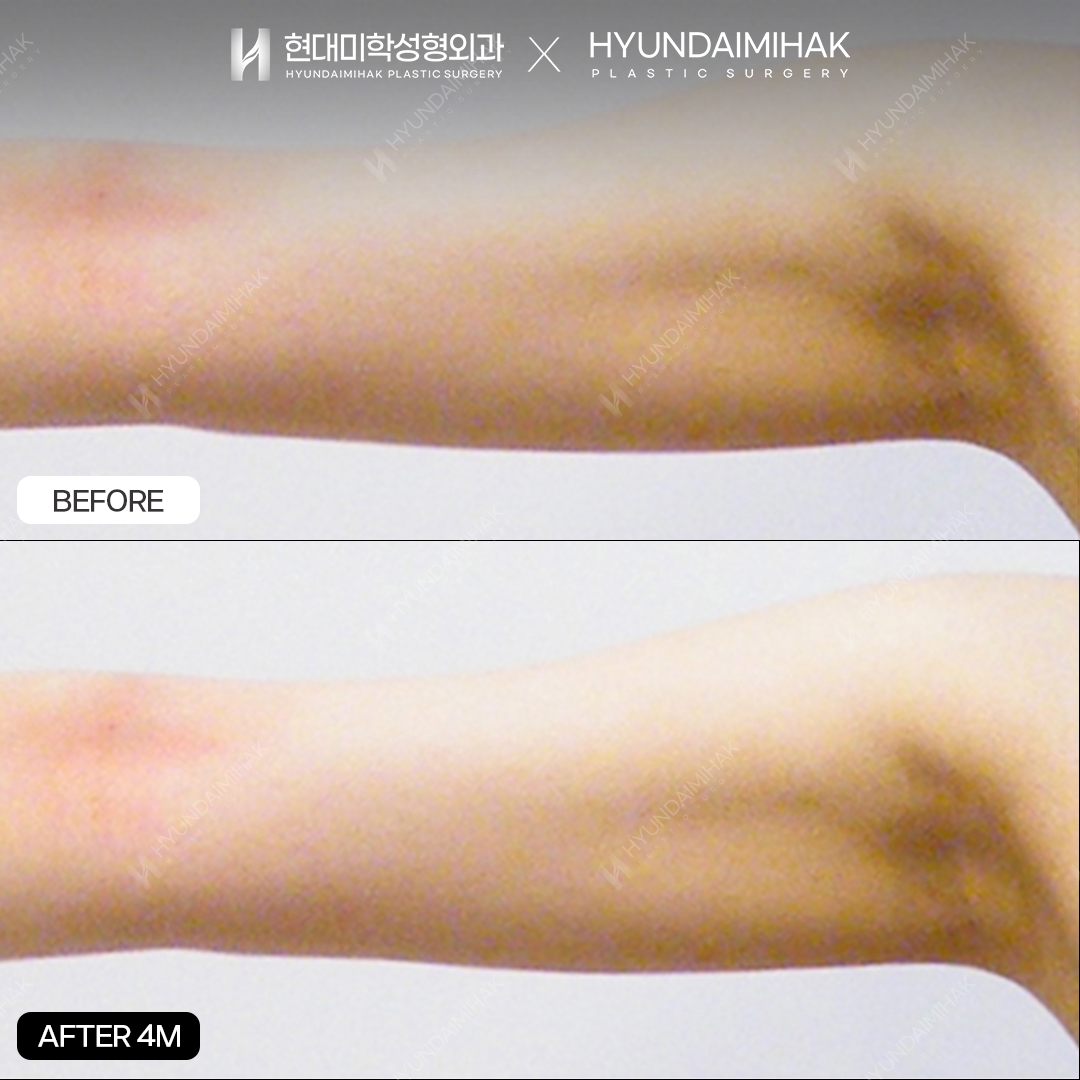 Arm liposuction, 4 months post-op
