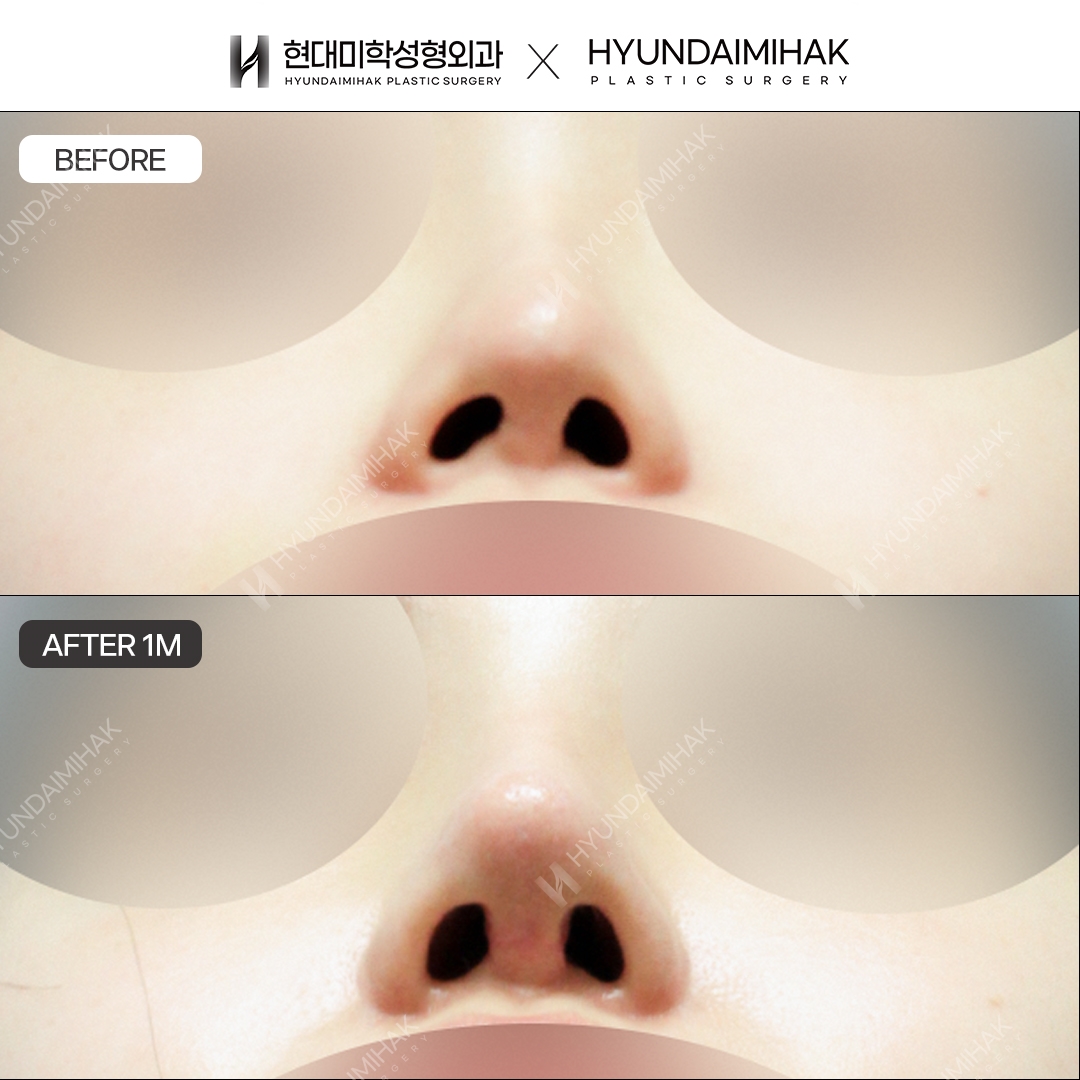 [Revision Rhinoplasty] Bridge + Tip, 1 Month